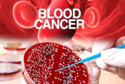 Blood Cancer Treatment - Blood Cancer Causes 51