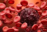 What is Blood Cancer High White Cell Count? 51
