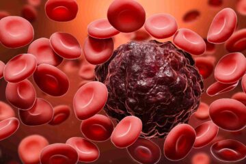 What is Blood Cancer High White Cell Count? 14