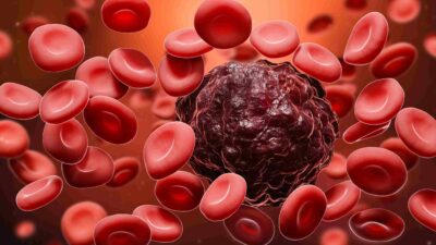 What is Blood Cancer High White Cell Count? 50