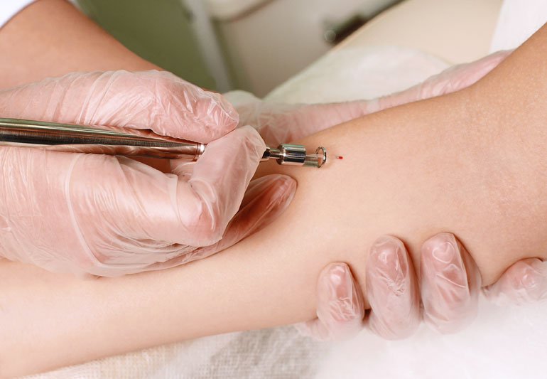 Skin Cancer Treatment - What Are The Best Treatments? 49