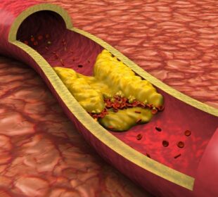 Cholesterol Hdl Levels - What Are They 56