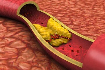 Cholesterol Hdl Levels - What Are They 5