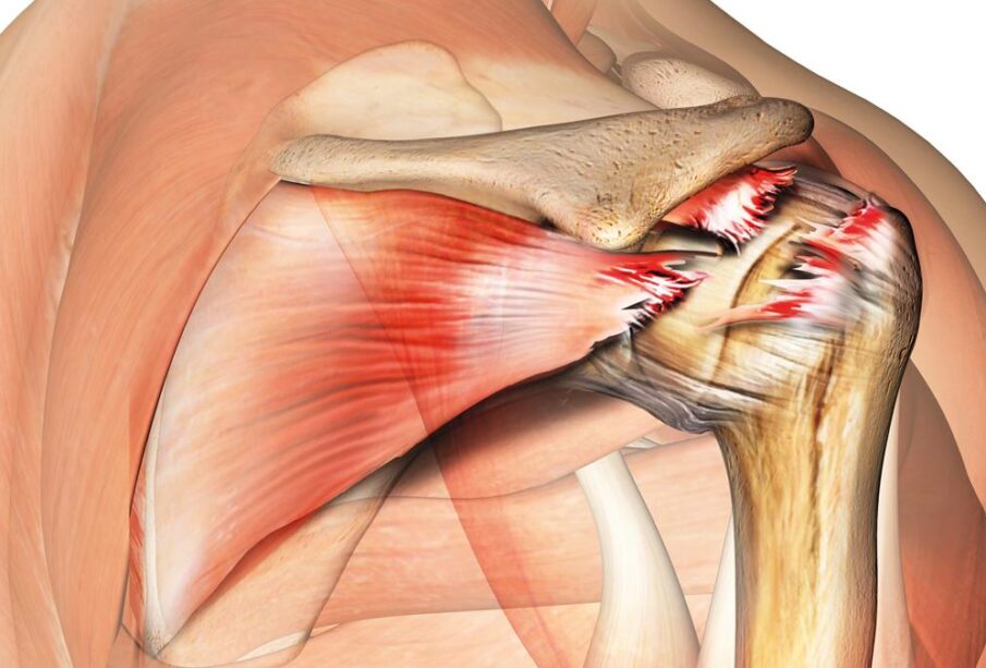 Rotator Cuff Injury Exercise Video 49