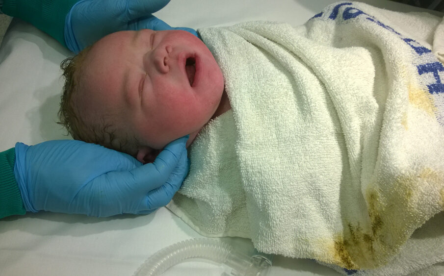 Persistent Pulmonary Hypertension of the Newborn - Causes, Symptoms, Diagnosis and Treatment 49