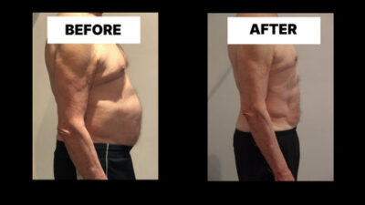 Understanding Diastasis Recti in Men 54