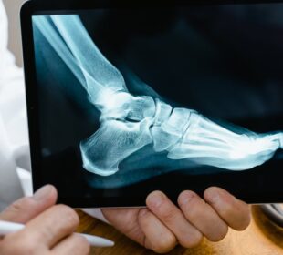 What to Expect from Hammer Toe Surgery 60