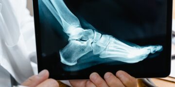 What to Expect from Hammer Toe Surgery 62