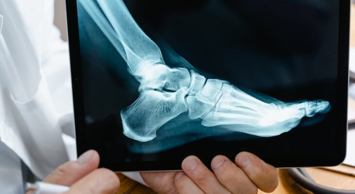 What to Expect from Hammer Toe Surgery 69
